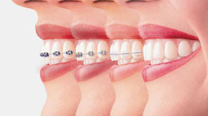 Hàm duy trì sau niềng răng là gì? Có những lưu ý gì khi sử dụng hàm duy trì?  