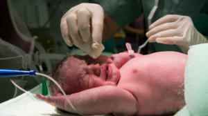 FACT CHECK: Can this weird head-pulling trick cure anxiety in adults born via C-Section?