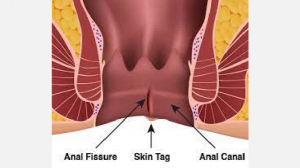 LASER FISSURE TREATMENT