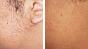 Affordable Electrolysis Hair Removal in Dubai