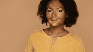 Understanding Vitiligo: Causes, Symptoms, and Natural Care Options