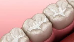 Can Dental Sealants Be Applied Over Cavities?
