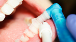 Can a Dental Cleaning Help Prevent Cavities and Gum Disease?