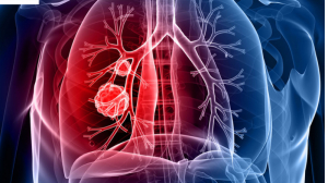 Accurate ICD-10 Codes for Lung Cancer Screening Procedures