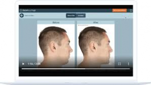 Plastic Surgery Visualization Using FaceTouchUp AI Simulator Showing Before and After Results