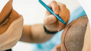 How Much Does a Hair Transplant Cost in Calicut Naturally?