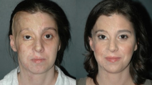 Advanced Techniques in Burn Reconstruction Surgery in Islamabad