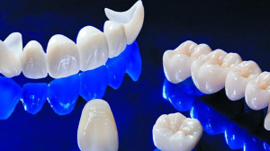 Step-by-Step Zirconia Crown Procedure in Islamabad