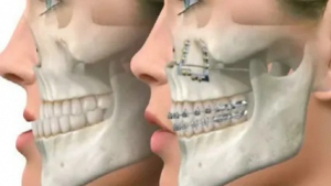 What Should You Know Before Getting Jaw Surgery in Islamabad?