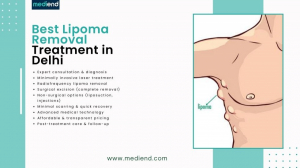 Best Lipoma Removal Treatment in Delhi