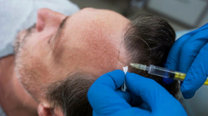 Why Does Hair Transplant Cost in Islamabad Vary Between Clinics?