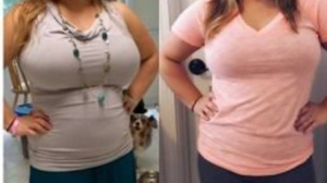 Gynecomastia in Dubai: Safe and Effective Male Breast Reduction