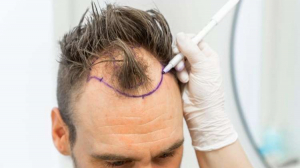 How FUE vs FUT Hair Transplant Differs: Which One Is Right for You?