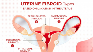 Fibroid Treatment in Chennai