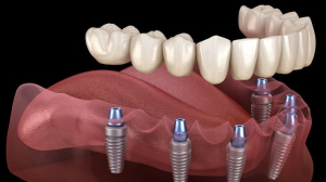 Why Revive Dental Mississauga Is Becoming the Most Recommended Dental Clinic in Mississauga