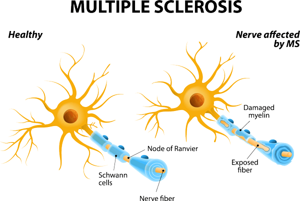 multiple sclerosis adobe