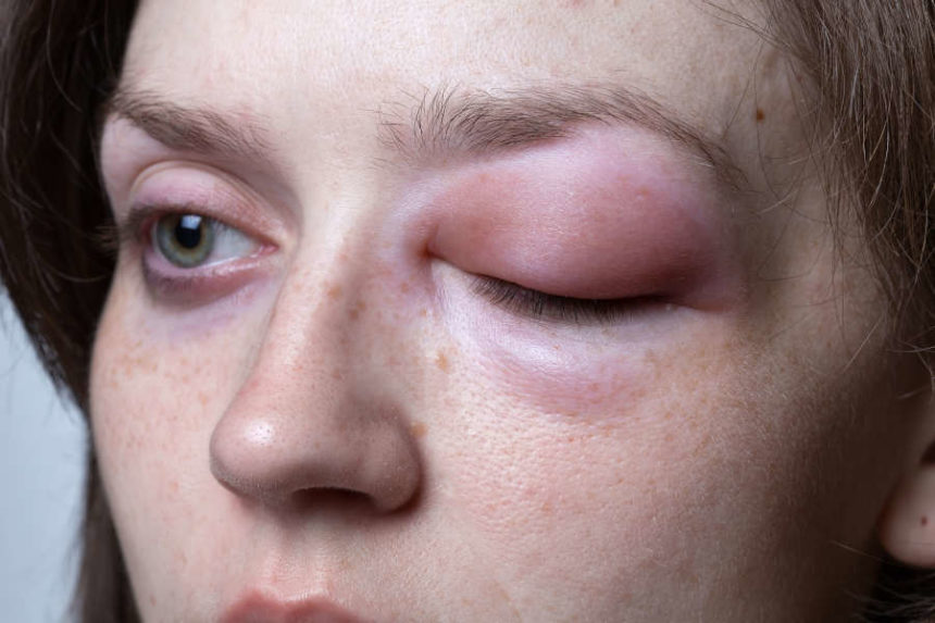 A woman with angioedema, which is often caused by an allergic reaction.