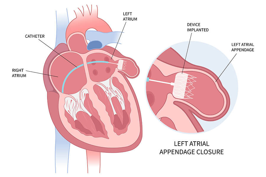 left-atrial-appendage-diagram