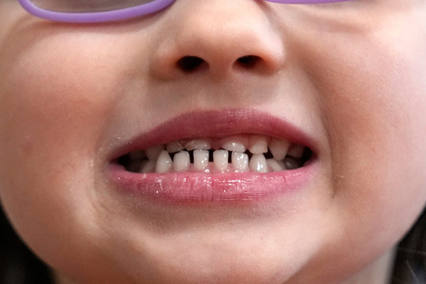 child showing teeth during dental exam