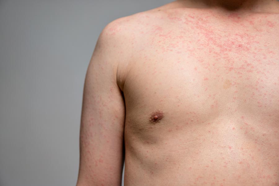 Idaho health officials confirm third measles case in unvaccinated child, suggesting higher spread