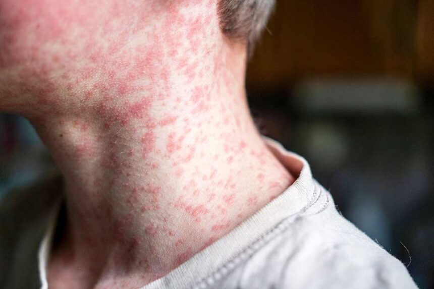 As of December 30, there have been 2,065 confirmed measles cases in the US in 2026, according to CDC data. Mandatory Credit: Natalya Maisheva/iStockphoto/Getty Images via CNN Newsource