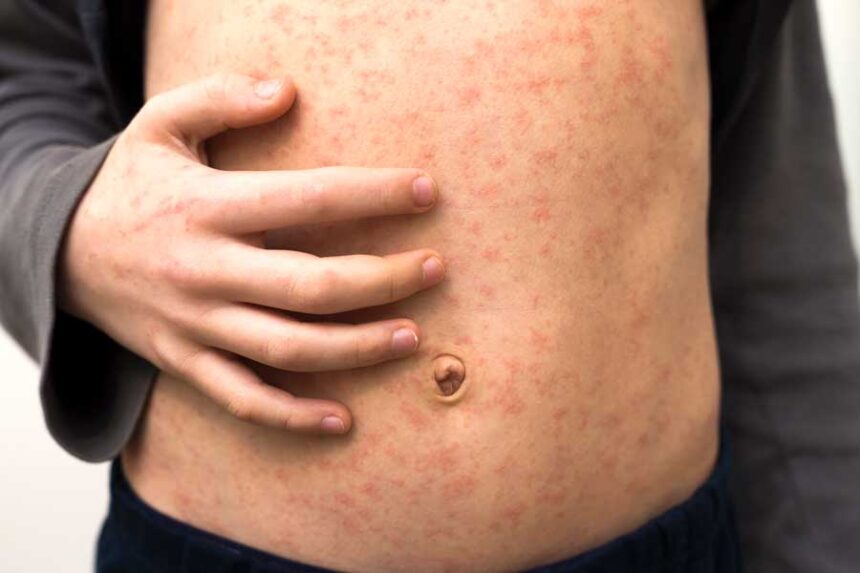 Sick child body, stomach with red rush spots from measles or chicken pox. Contagious child diseases and treatment.