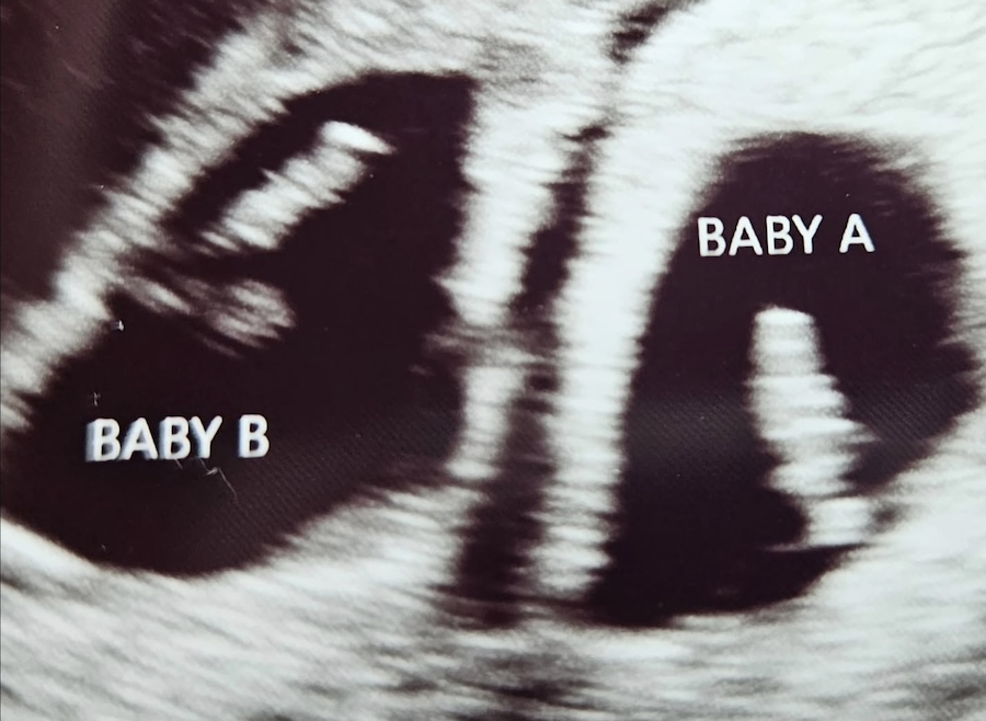 ultrasound twins