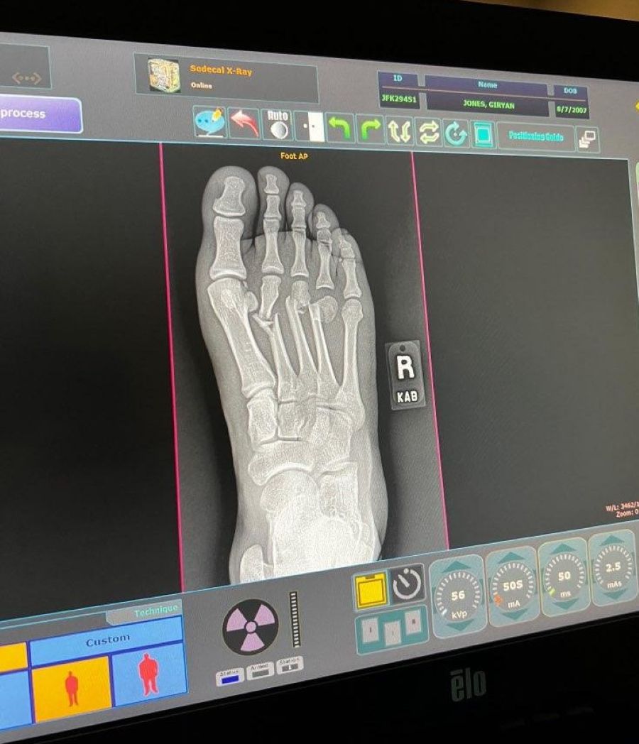 An X-ray shows the broken bones Giryan Jones suffered in a motorcycle crash. | Courtesy photo.