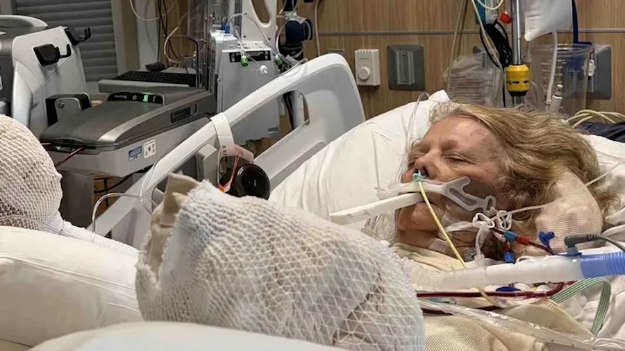 Woman suffers severe burns and heat stroke after falling asleep at community pool