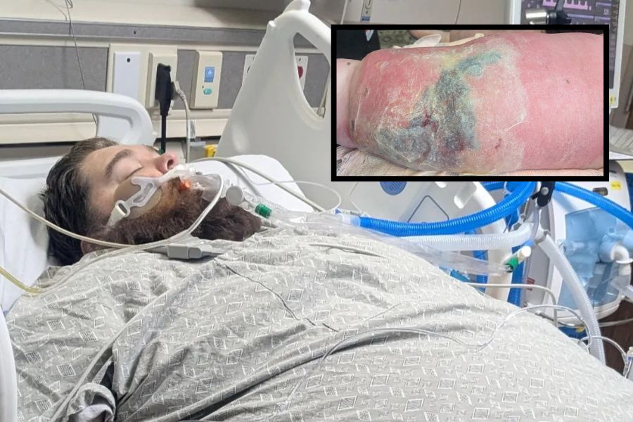 Local father in ICU after contracting flesh-eating bacteria in his leg - East Idaho News