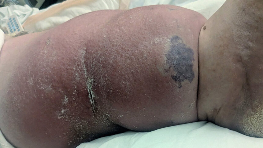 Jon McCoy's leg turning black when he arrived at EIRMC. | Courtesy of Monica McCoy
