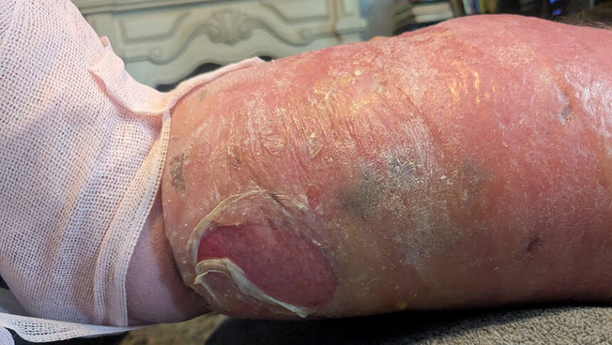 Jon McCoy's leg, which has a flesh-eating bacteria. | Courtesy of Monica McCoy