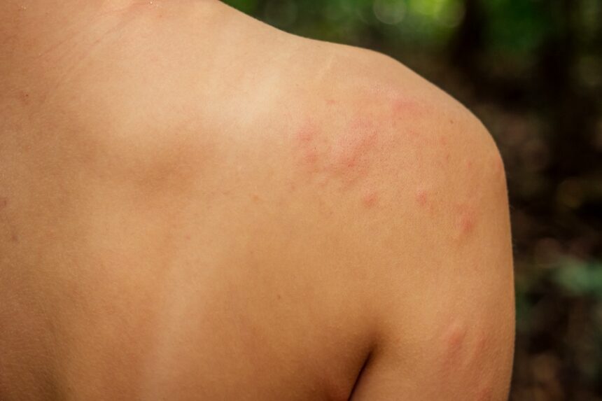 shoulder with rash in nature setting 2026 09 22 19 01 55 utc