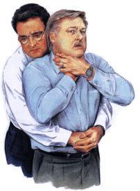 Heimlich maneuver