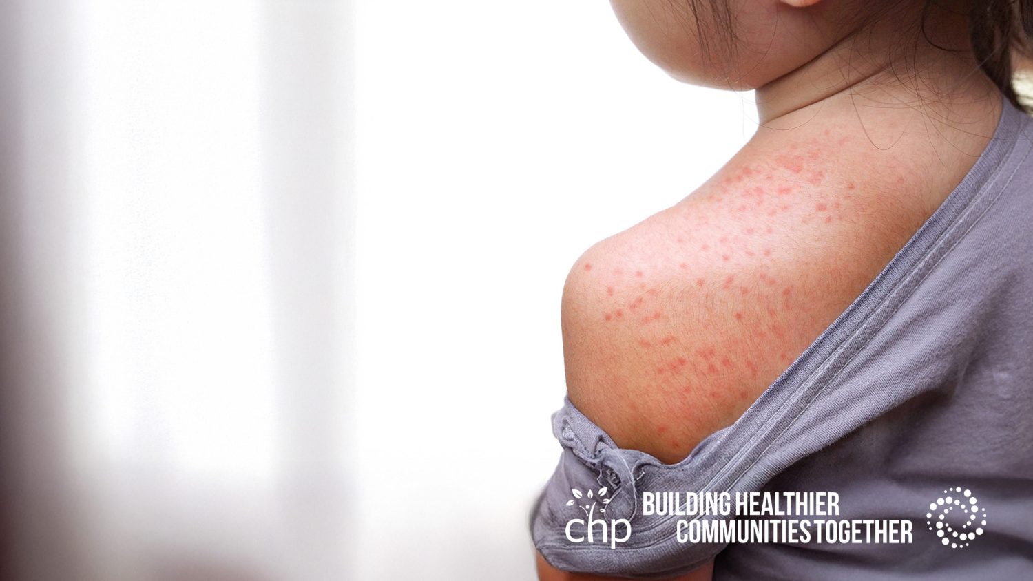 What You Need to Know About the Measles Outbreak in the Gallatin Valley