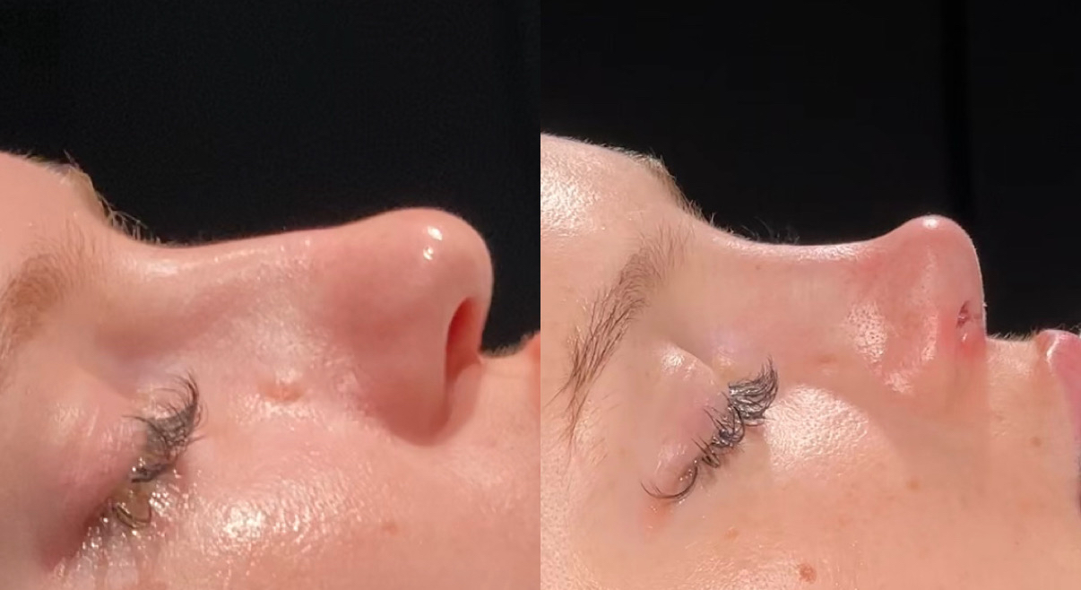 before after nose 