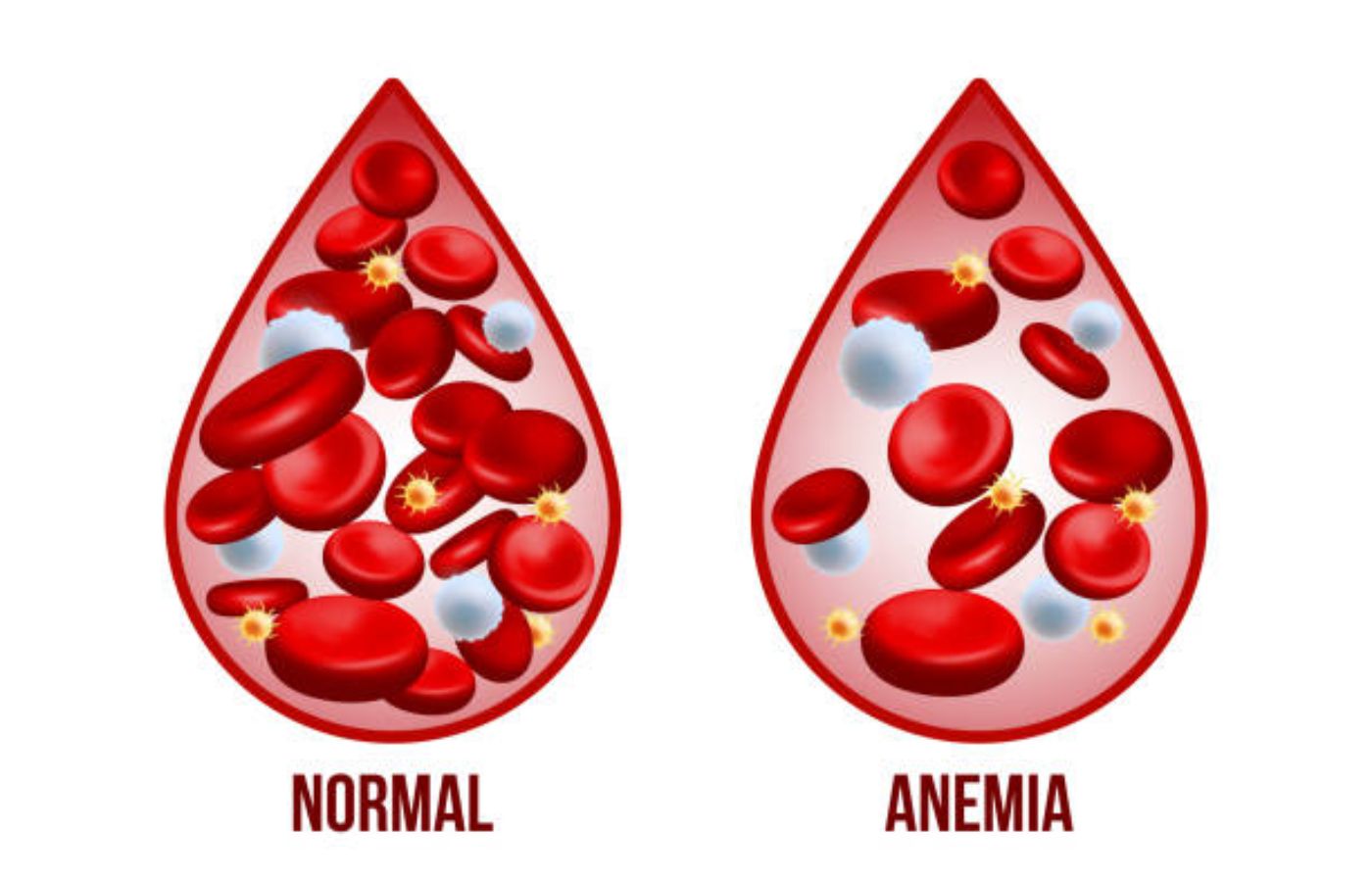 Anemia