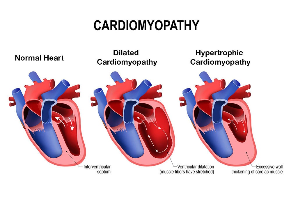 high blood pressure can cause cardiomyopathy