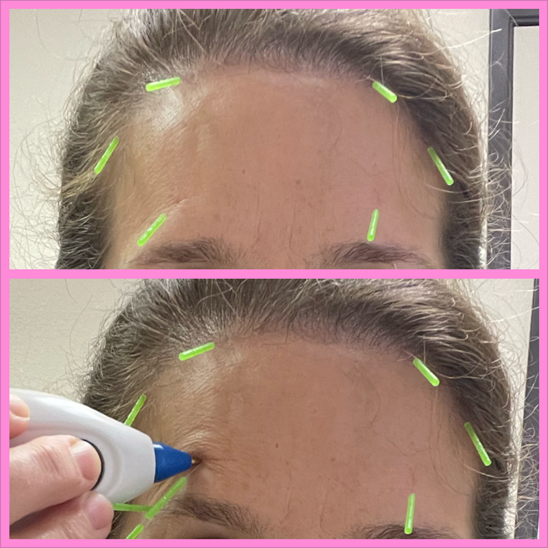 acupuncture points GB 14, 15, St 8, TW 23, Yuyao