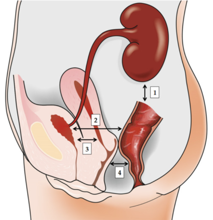 Schéma anatomique illustrant les voies de passage des bactéries (dont Escherichia coli) entre l’intestin, le vagin et la vessie chez la femme. L’image met en évidence la proximité des organes et le rôle des muqueuses dans la survenue des cystites récidivantes