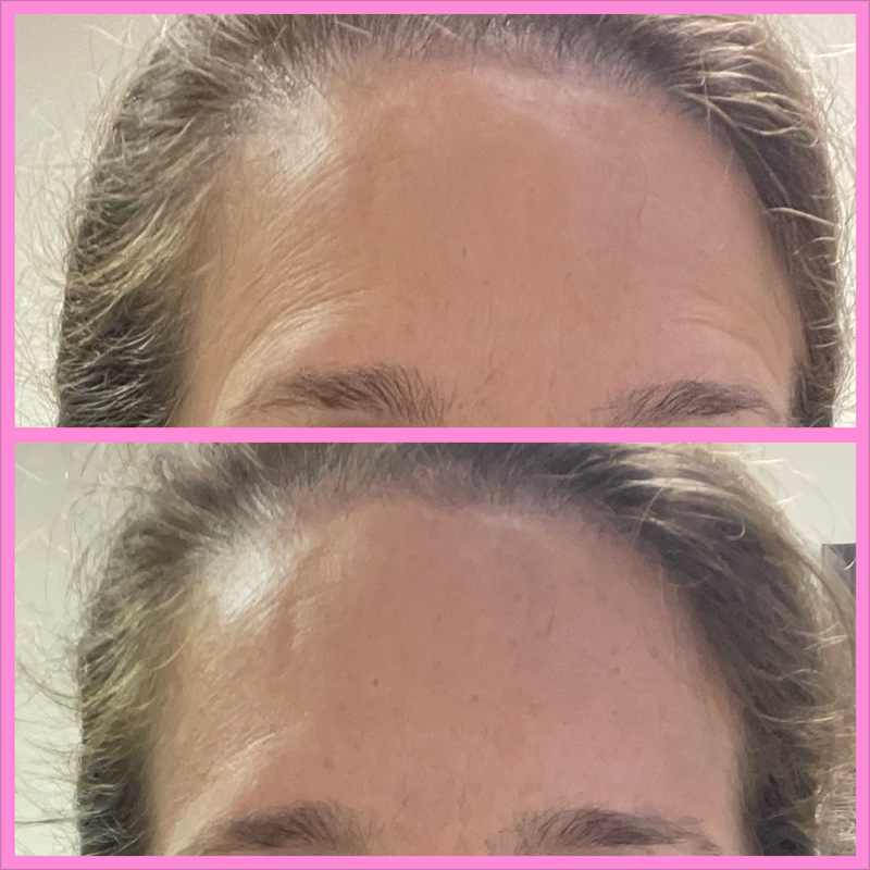 My before and after forehead amazing