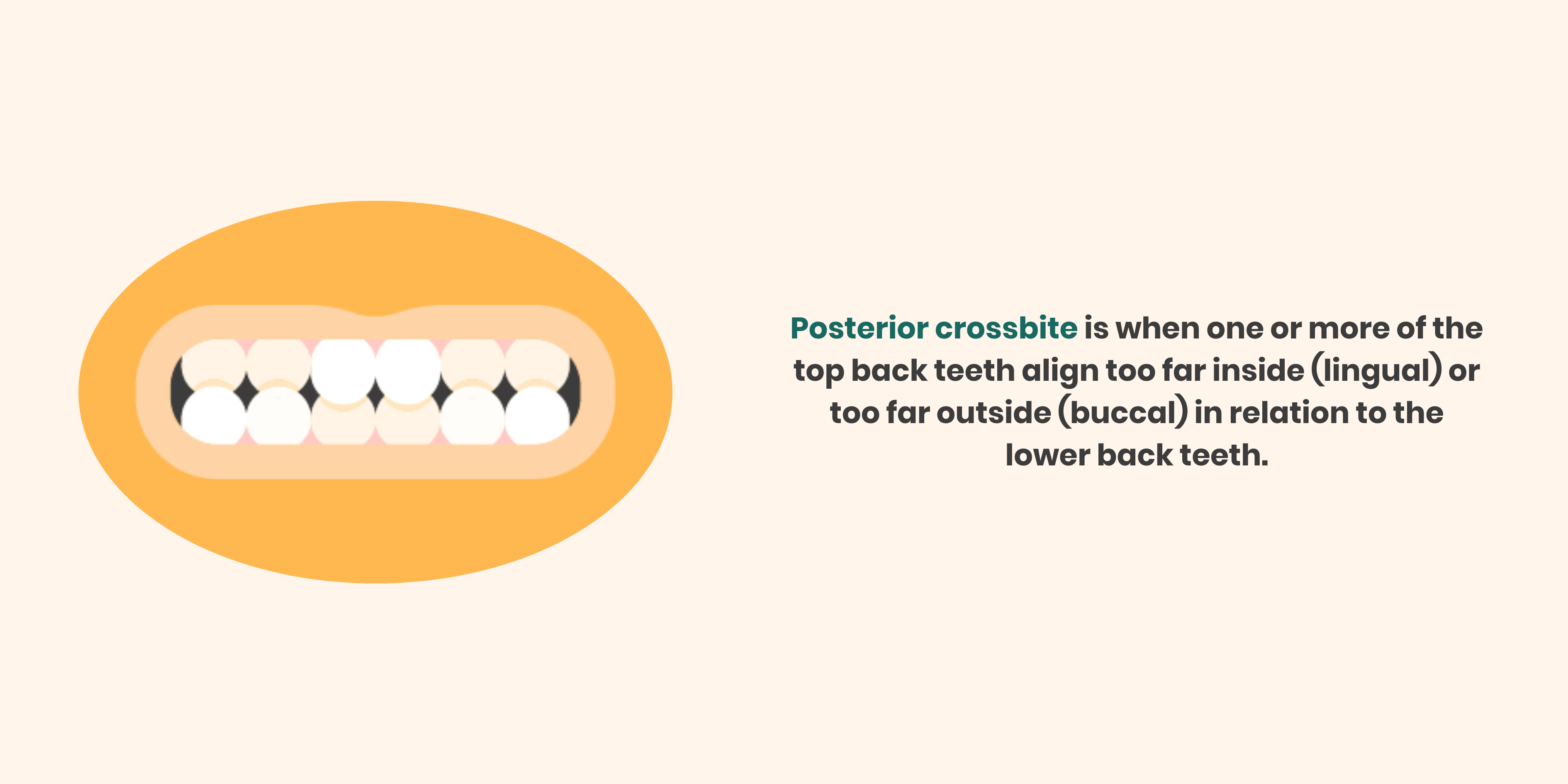 posterior crossbite