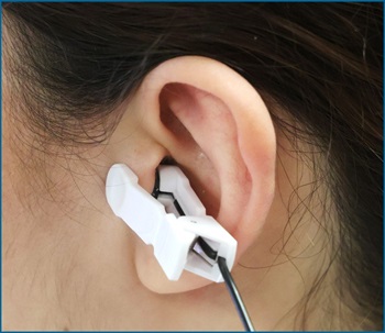ear tragus vagus nerve stim with Dolphin