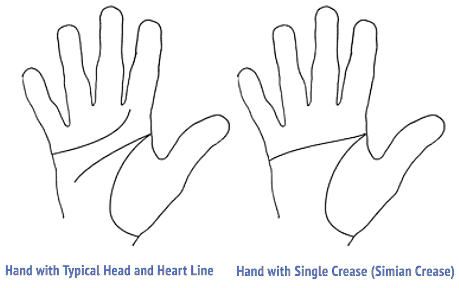 Diagram showing a typical palm with head and heart line next to a palm with a single palmar crease
