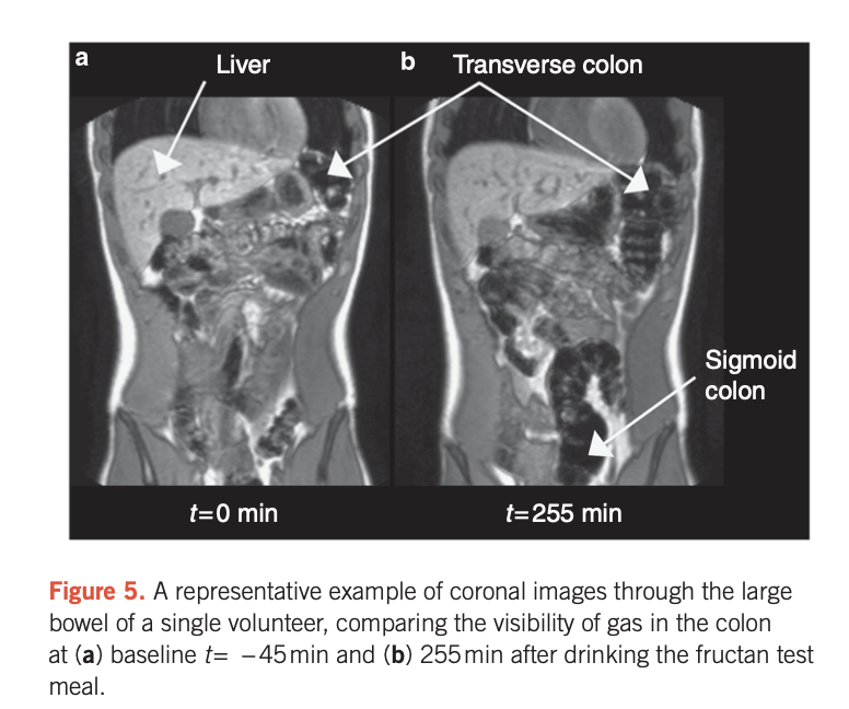 gaz dans le côlon fructanes FODMAP