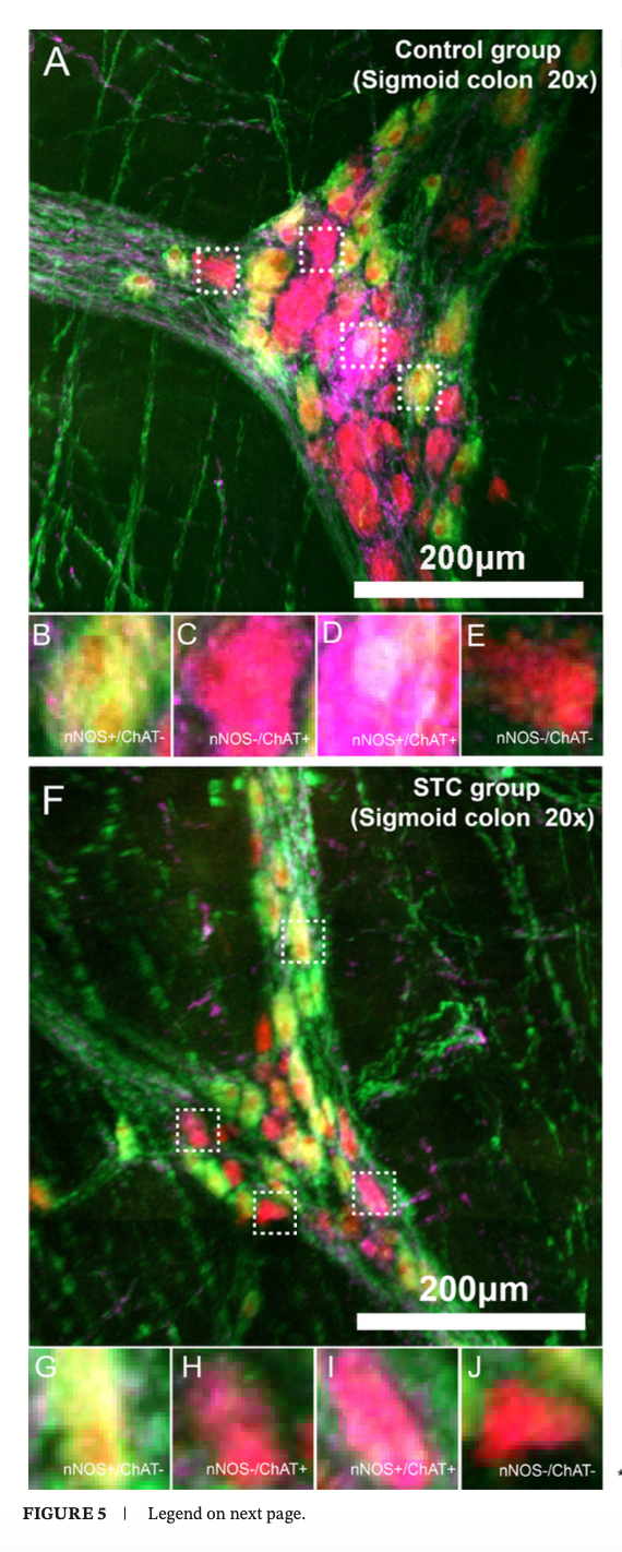 constipation chronique