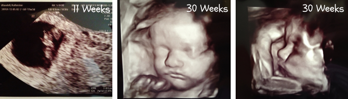 ultrasound