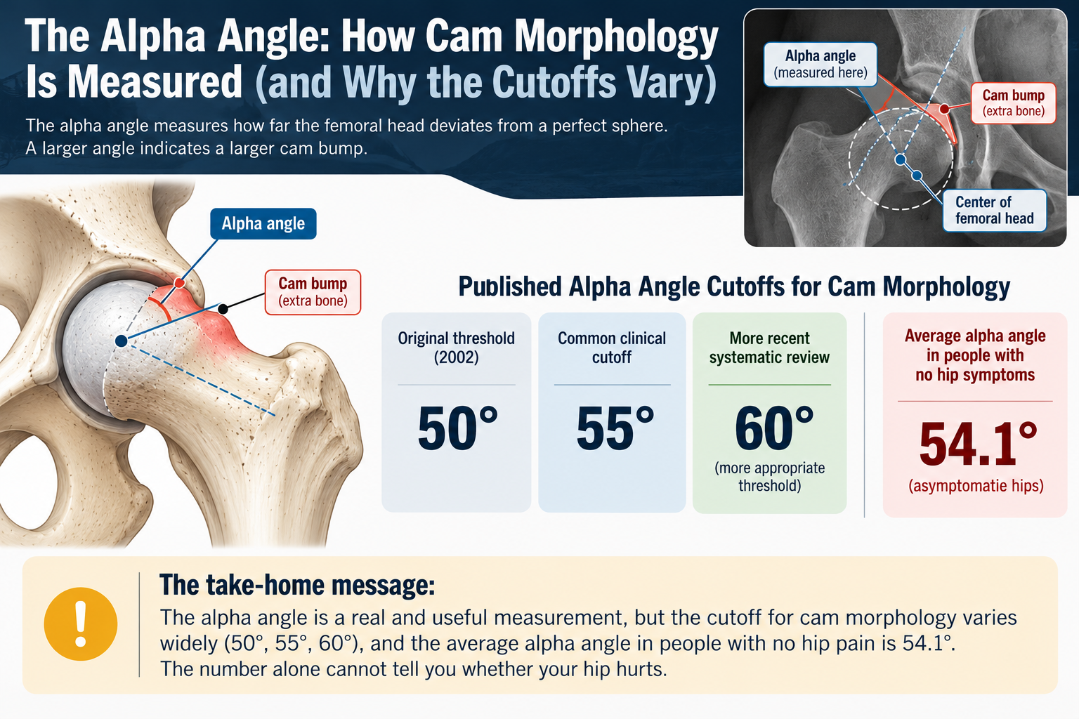 Infographic explaining the hip alpha angle used to measure cam morphology in femoroacetabular impingement (FAI), comparing 50°, 55°, and 60° thresholds with the 54.1° average in asymptomatic hips.  Copy alt text