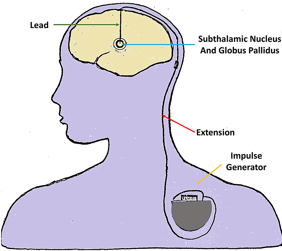 Deep Brain Stimulation for Parkinson’s Disease