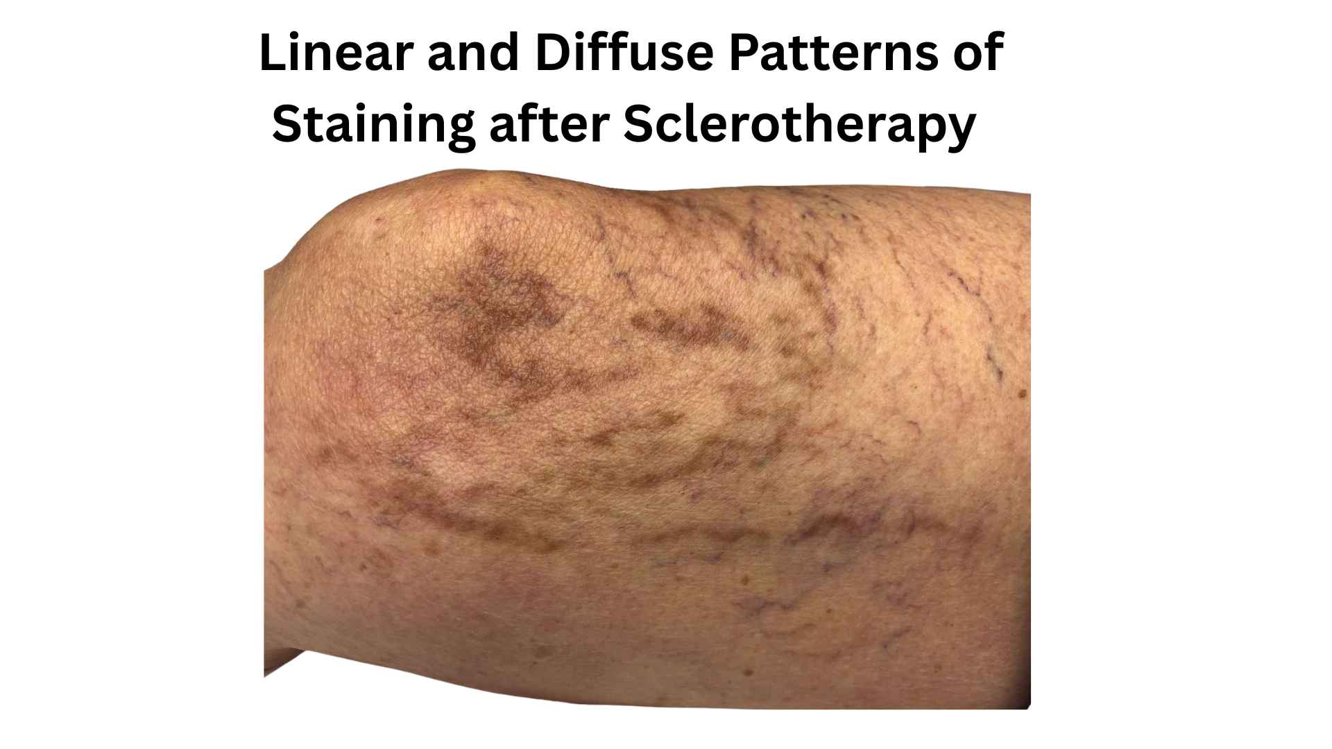 Linear and diffuse patterns of staining after sclerotherapy 